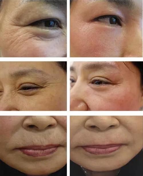 美容除皱仪器大介绍,介绍不同仪器的优劣对比_美容除皱仪器对比图 美容除皱仪器大介绍,介绍不同仪器的优劣对比_美容除皱仪器对比图 美容塑身