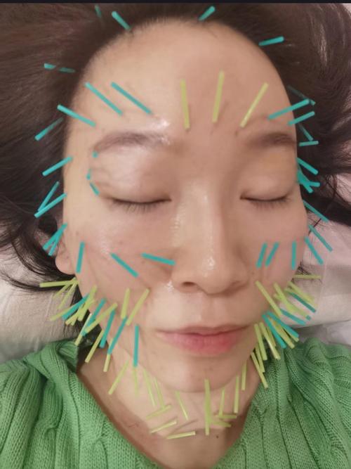 无针针灸美容,科技与自然的完美融合 无针针灸美容,科技与自然的完美融合 日用科普