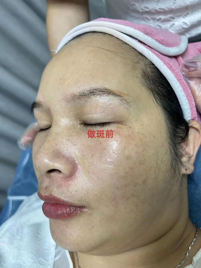 激光祛斑,科技美容的新宠，效果显著，安全可靠 激光祛斑,科技美容的新宠，效果显著，安全可靠 养生保健