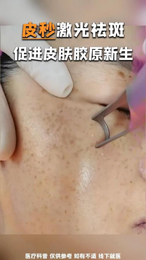 激光美容,科技之光下的美丽蜕变 激光美容,科技之光下的美丽蜕变 家居时尚