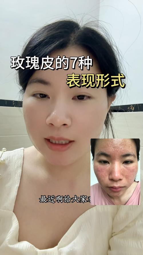 玫瑰皮与美容仪器,完美融合的科学美肌之旅 玫瑰皮与美容仪器,完美融合的科学美肌之旅 日用科普