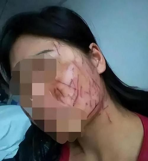 美容仪器伤脸,介绍那些毁容的“美丽陷阱” 美容仪器伤脸,介绍那些毁容的“美丽陷阱” 日用科普